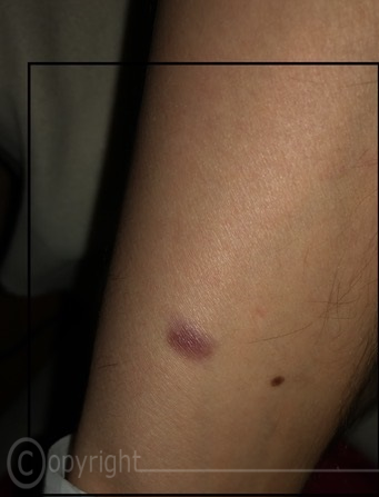 Linker Arm Innenseite nähe Handgelenk